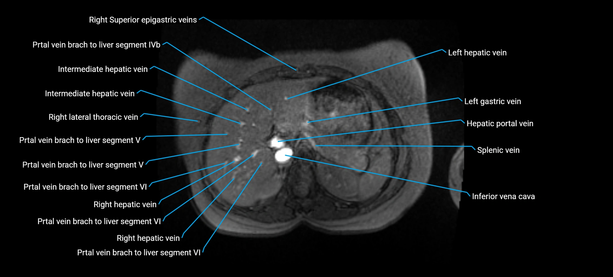 MRV abdomen pelvis & lower limb axial cross sectional anatomy labelled MRI image 44 (1).webp